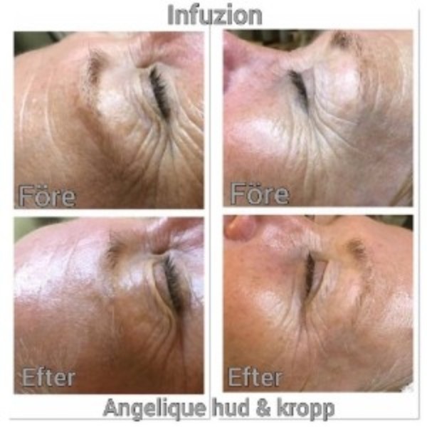 Infuzion skinbbodster hos Angelique hud & kropp