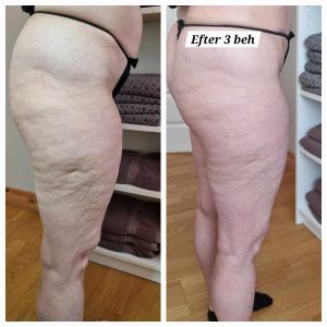 anti-cellulit behandling