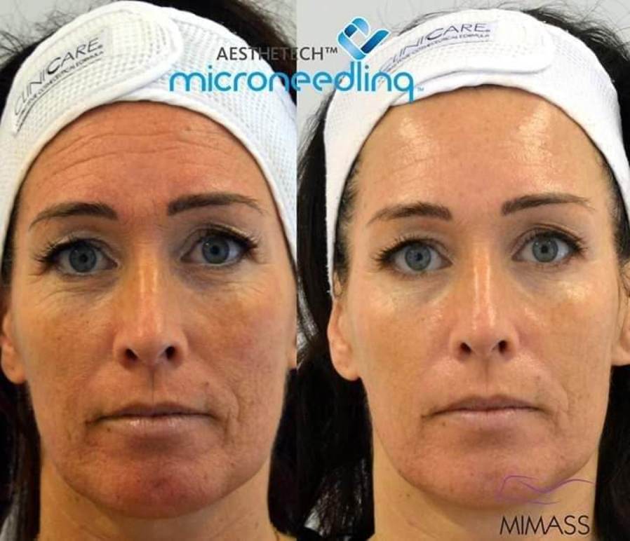 MIcroneedling , ärr, pigment, rynkor, Helsingborg